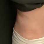 after bodytite morpheus8 treatment