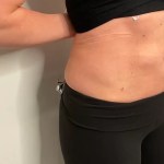 after bodytite treatment