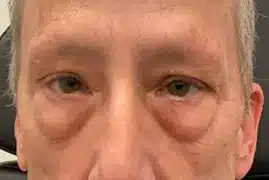 before accutite under eye treatment before accutite under eye treatment