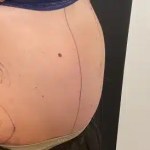 before bodytite morpheus8 treatment