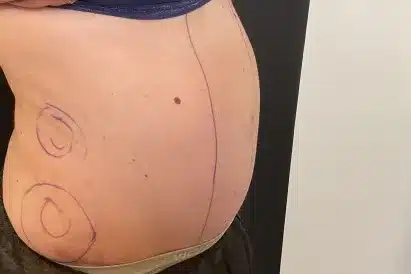 before bodytite morpheus8 treatment before bodytite morpheus8 treatment