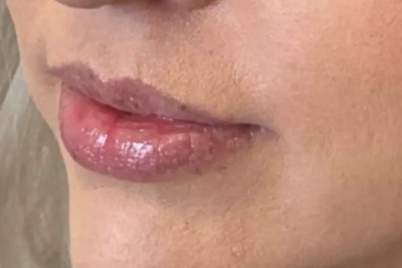 before botox treatment before botox treatment