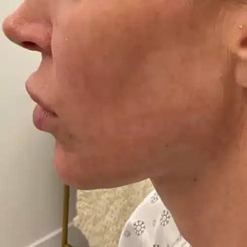 before facelift treatment in ogden utah before facelift treatment in ogden utah