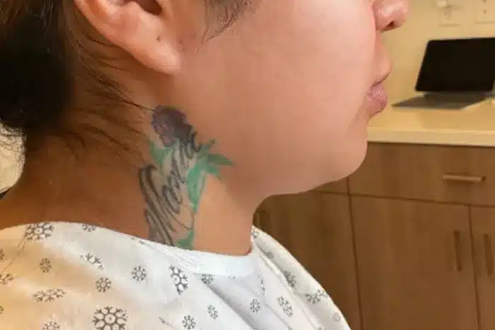 before jawline facetite and double chin treatment before jawline facetite and double chin treatment