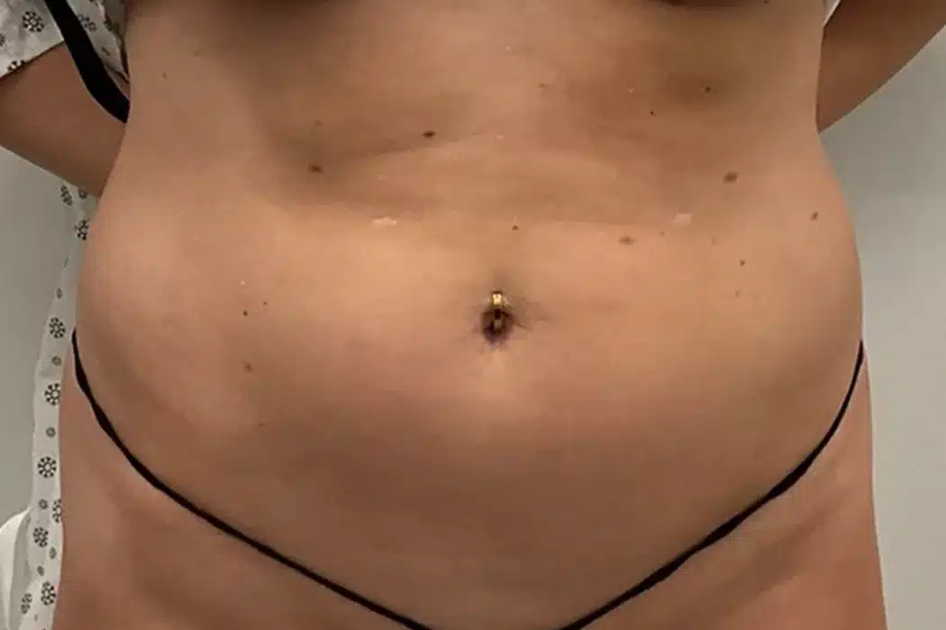 tummy bodytite before treatment tummy bodytite before treatment