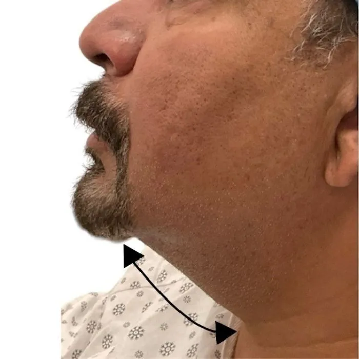 before laser lipo before laser lipo