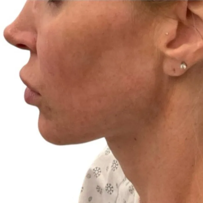 before lipo in royale aesthetics and beauty before lipo in royale aesthetics and beauty