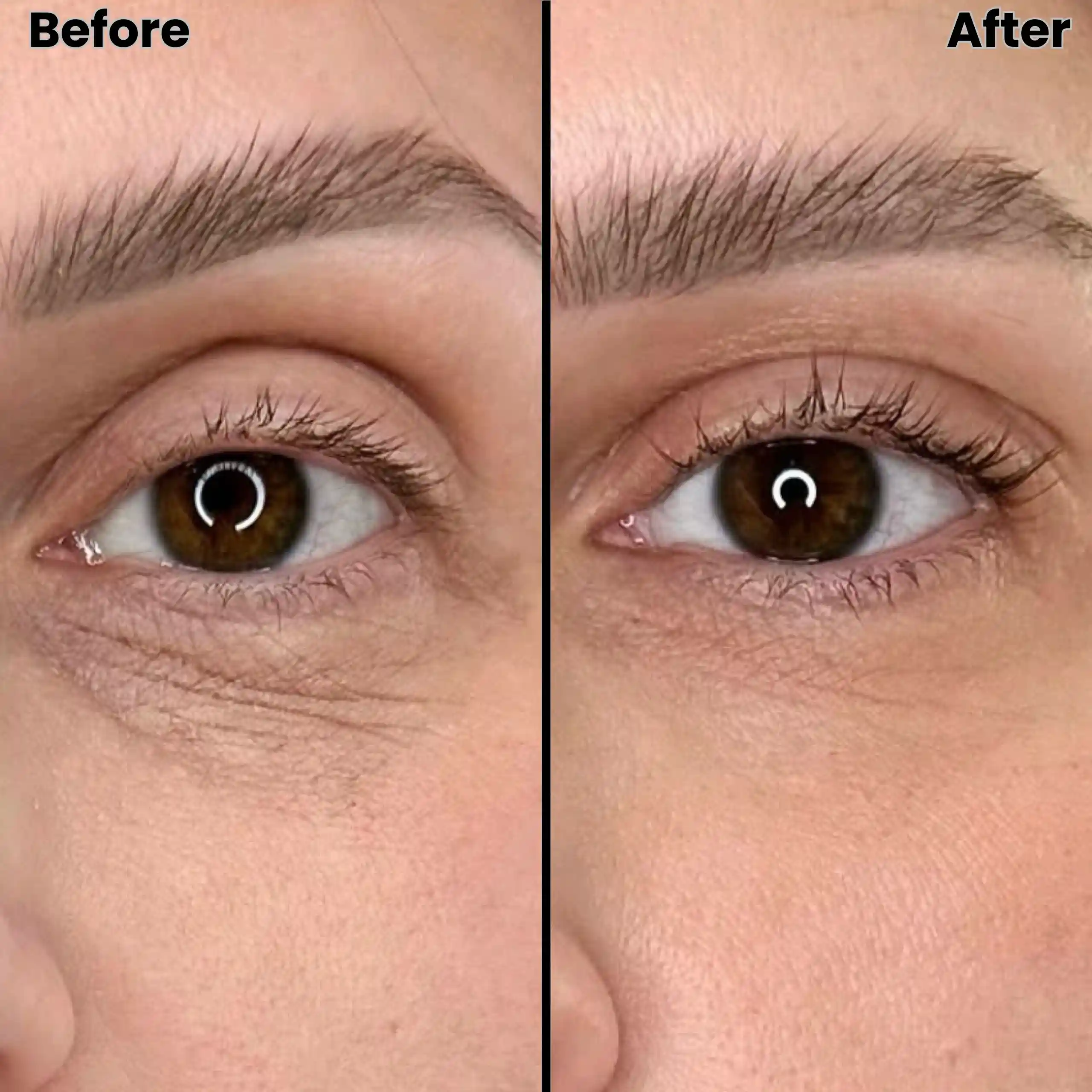 RF Microneedling Ogden, Utah
