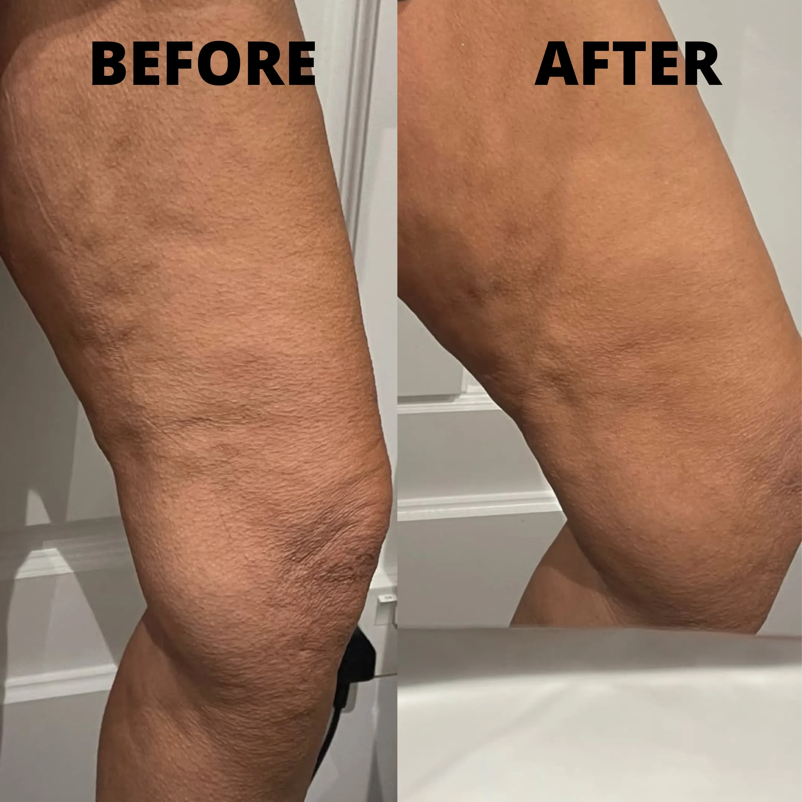 Cellulite Treatment in Ogden, Utah – Best Methods