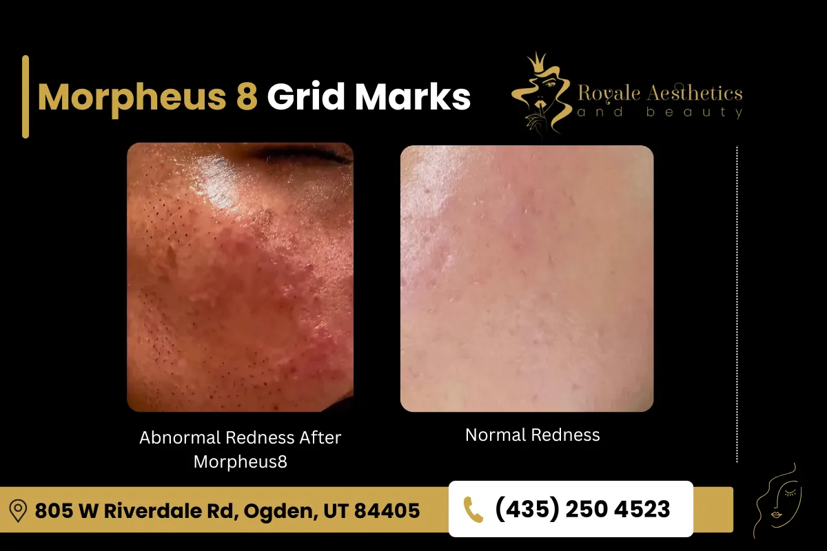 Abnormal Vs Normal Redness Post Morpheus8