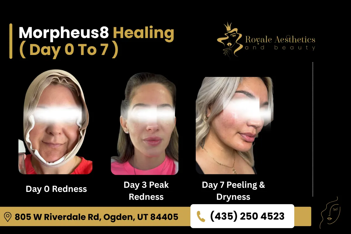 Day 0, 3, and 7 After Morpheus8