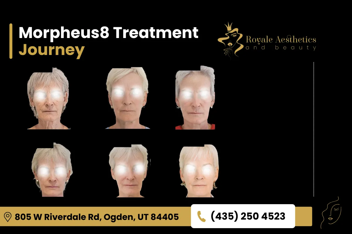 Morpheus8 Treatment Journey