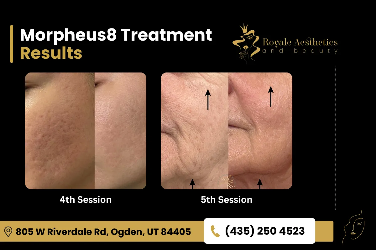 Results Of Morpheus8 After 6 Sessions