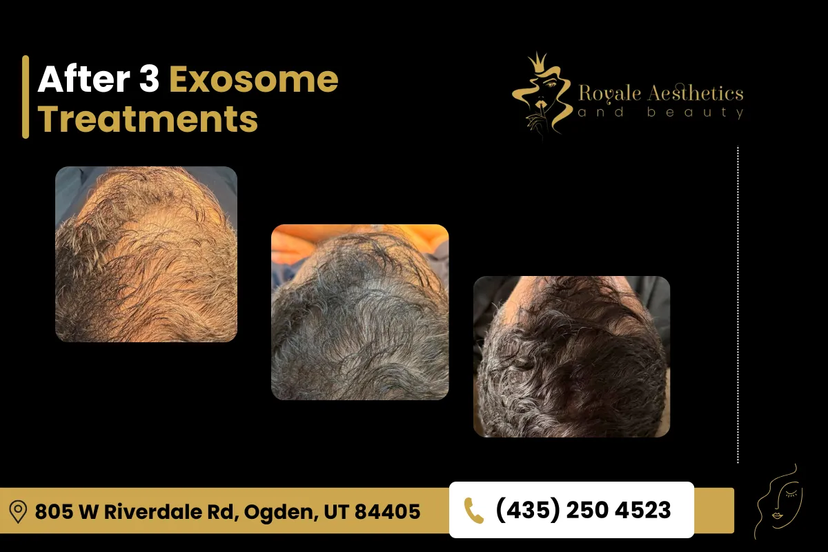 Results of Exosome Therapy