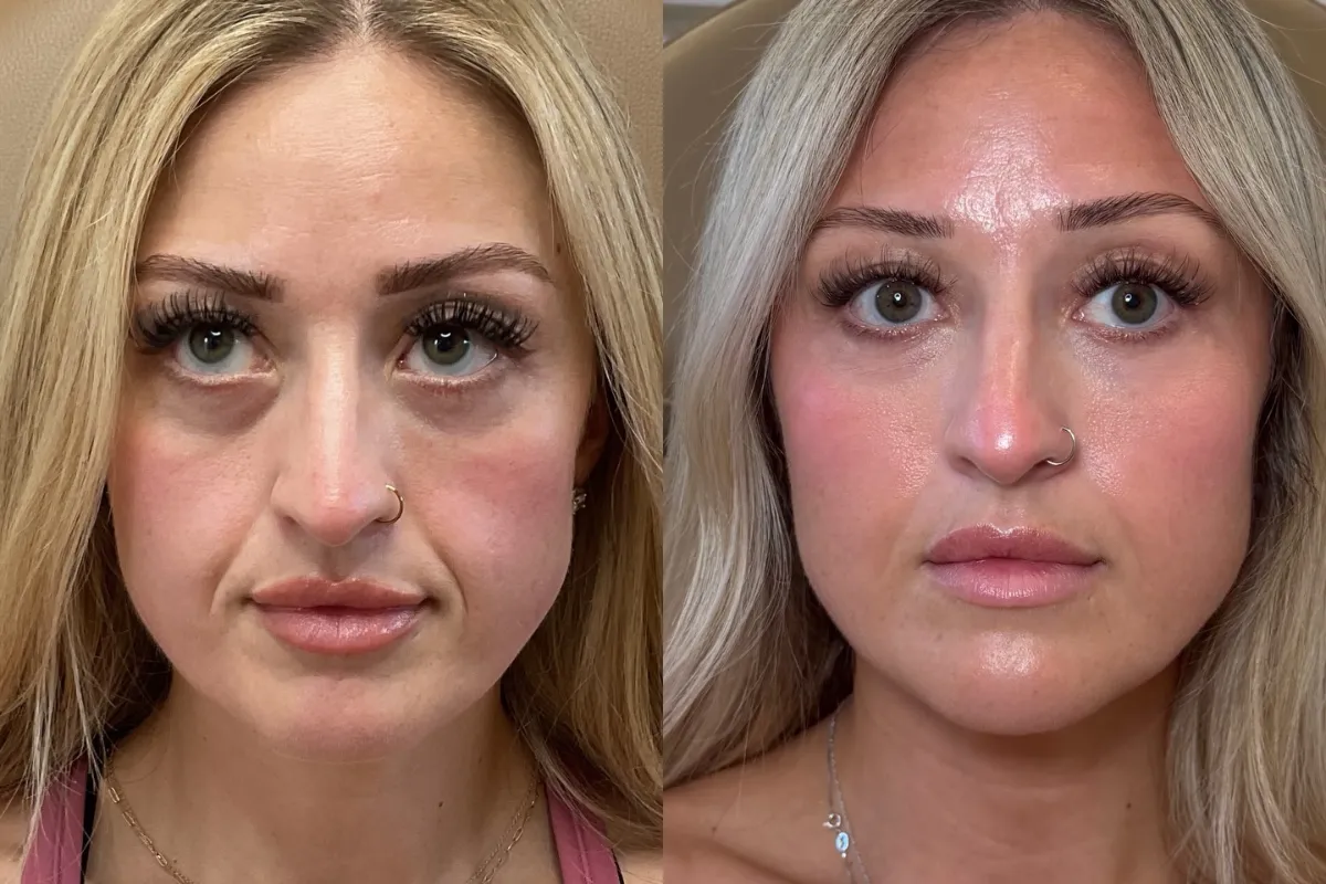 Sculptra Results After 3 Months